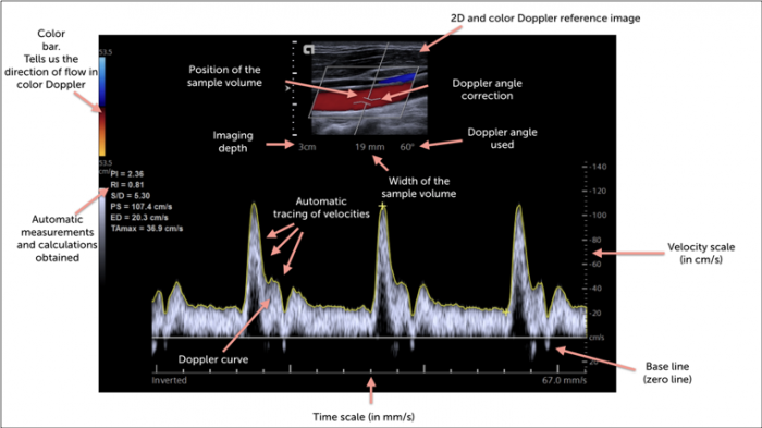 6 Spectral Doppler 123 Sonography